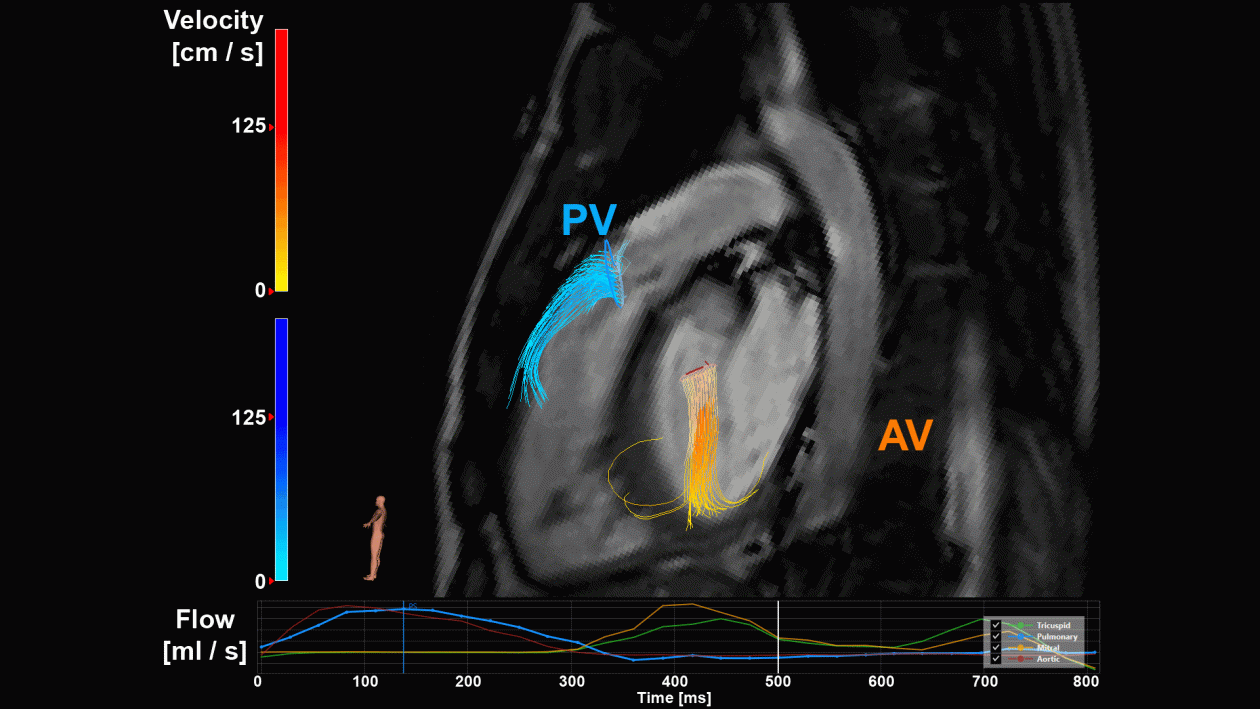 Het dichten van de kloof tussen onderzoek en klinische praktijk: Het voorbeeld van 4D flow MRI