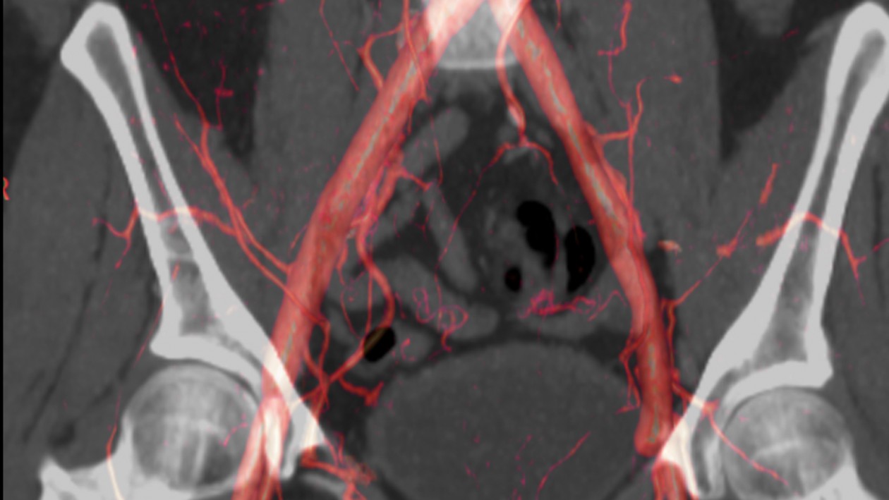 Preventieve 3D-echografie tegen gebarsten aneurysma