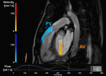 Het dichten van de kloof tussen onderzoek en klinische praktijk: Het voorbeeld van 4D flow MRI