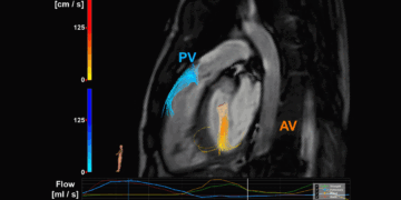 Het dichten van de kloof tussen onderzoek en klinische praktijk: Het voorbeeld van 4D flow MRI